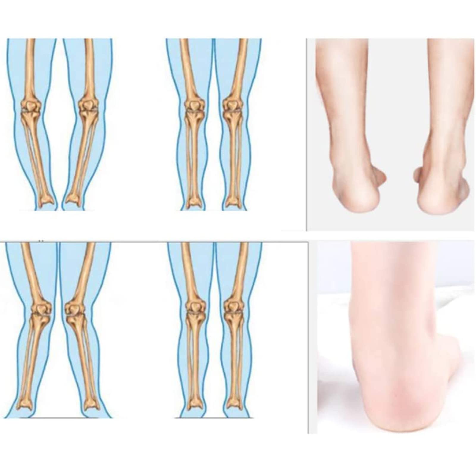 Ortheseneinlagen X/O Typ Beine Ortheseneinsätze Für Plattfüße, Plantarfasziitis, Knochensporn, Fußgewölbestütze Für Männer Und Frauen