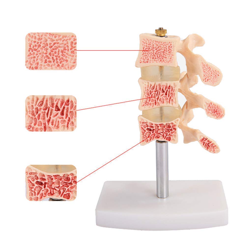 Sjdopulse Human Skeleton Model, Osteoporosis Lesion Model, Used For Doctor-Patient Communication And Medical Education