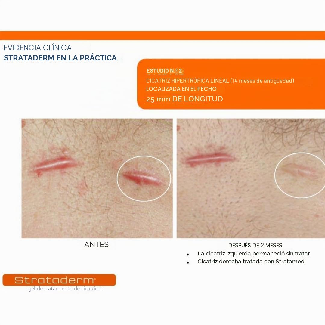 Strataderm Gel para terapia profesional de cicatrices para cicatrices viejas y nuevas, 5 gramos