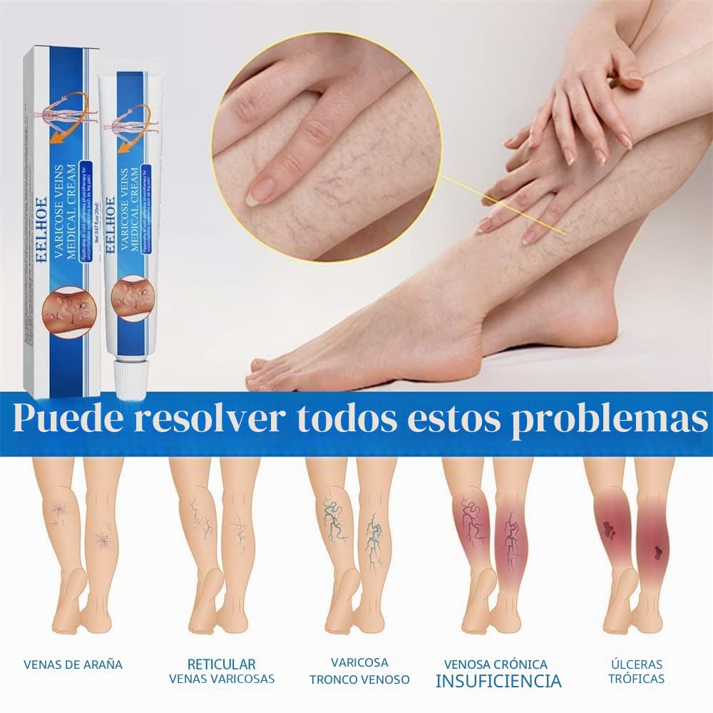 Veinshealth - Terapia de luz azul para venas varicosas (2 cremas + 1 bolígrafo)