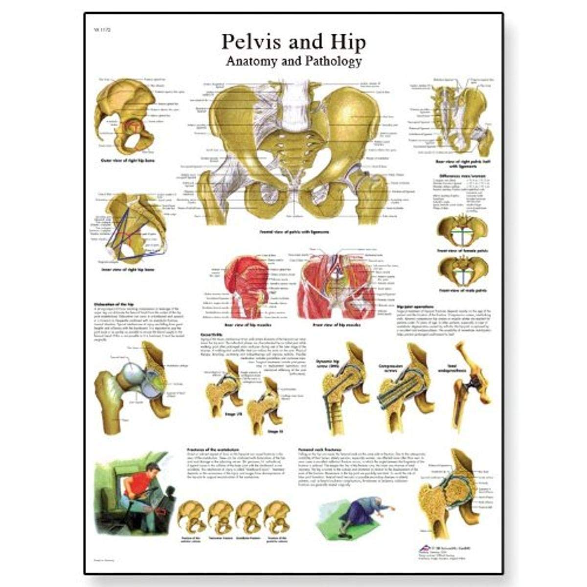 3B Scientific VR1172L Glossy Laminated Paper Pelvis and Hip Anatomi and Pathology Chart, Poster Size 20" Width x 26" Height