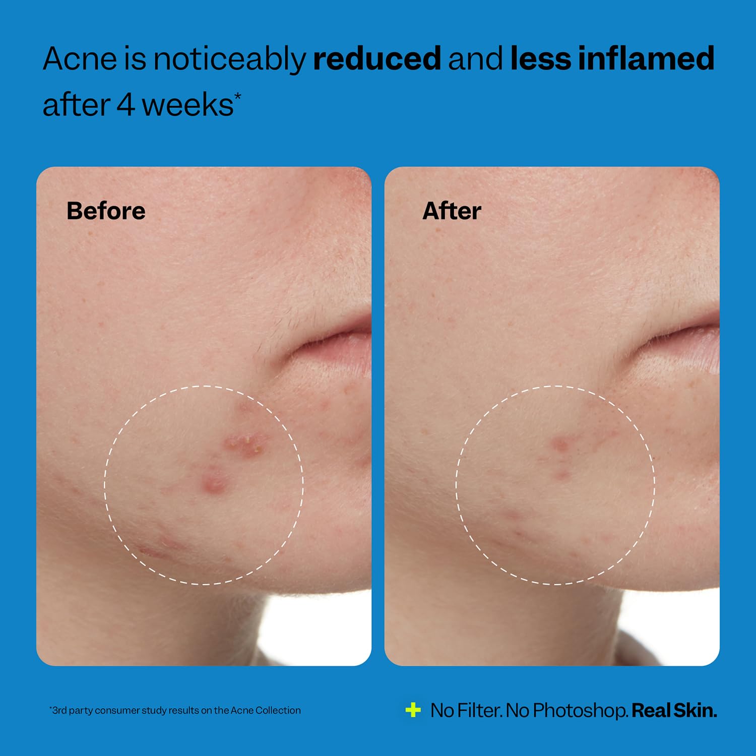 Peach Slices - 3-Step Acne Starter Kit (3 Products) - Skin Care Set - 1 Toner, 1 Cleanser, 1 Oil Free Moisturizer - 2% Salicylic Acid & Botanicals - Vegan & Cruelty Free - Korean Skin Care & Beauty - Image 5