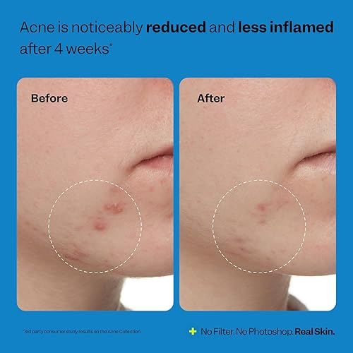 Miniatura 5 de Peach Slices - Kit de inicio de acné de 3 pasos (3 productos) - Set de cuidado de la piel - 1 tónico, 1 limpiador, 1 hidratante sin aceite - 2% de