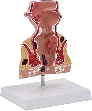 Pathologies of Rectum Model Human Rectum Model Human Anatomical Easy to Use Medicals Teaching Aid Pathologies of