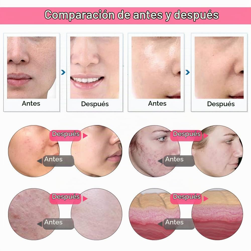 [Versión Mejorada] 65-68 cmHg Dispositivo Profesional de Dermoabrasión, Microdermoabrasión de Diamante, Peeling Facial, Equipo de Belleza para Salón y Uso Doméstico
