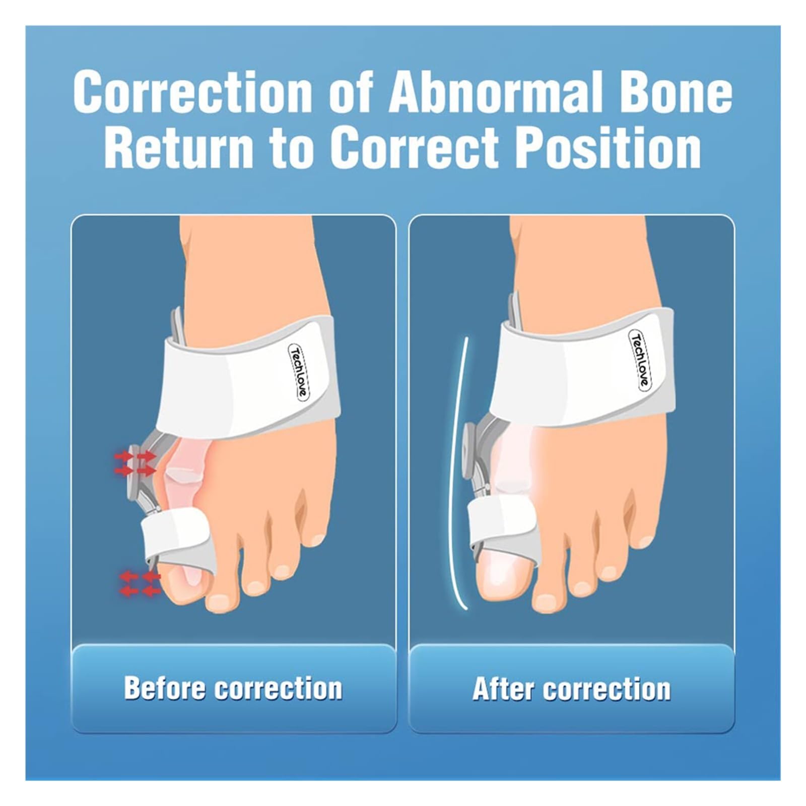 Corrector de férula ajustable para juanetes con perilla para corrección de hallux valgus, suministros ortopédicos para el cuidado de la pedicura (2 unidades)