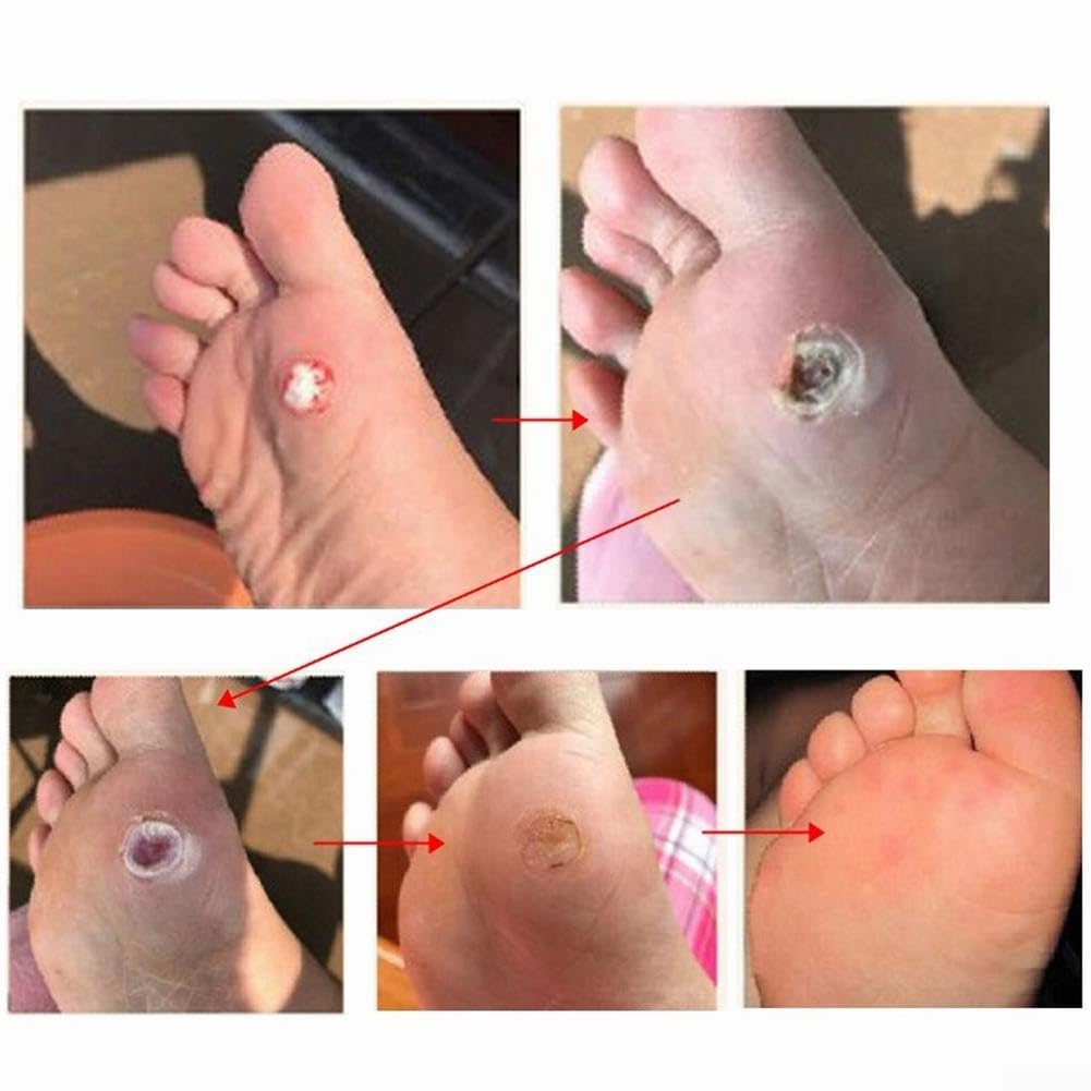 Almohadillas removedoras de callos para pies, parche de yeso de espina de verrugas para callo, verrugas plantares y eliminación de piel dura, paquete de 48 piezas, fórmula de ácido salicílico