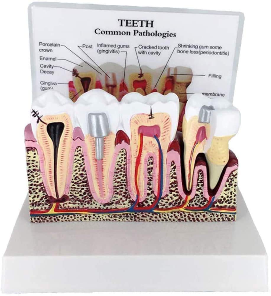 Modelo De Enfermedad Modelo Anatómico De Implantes Dentales De Atención Dental, Dientes Removibles, para Presentaciones Médicas Y Formación En Higiene