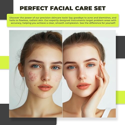 Miniatura 5 de 6 piezas Herramientas para eliminar puntos negros para el acné, kit de herramientas quirúrgicas de acero inoxidable para reventar, kit de extracción