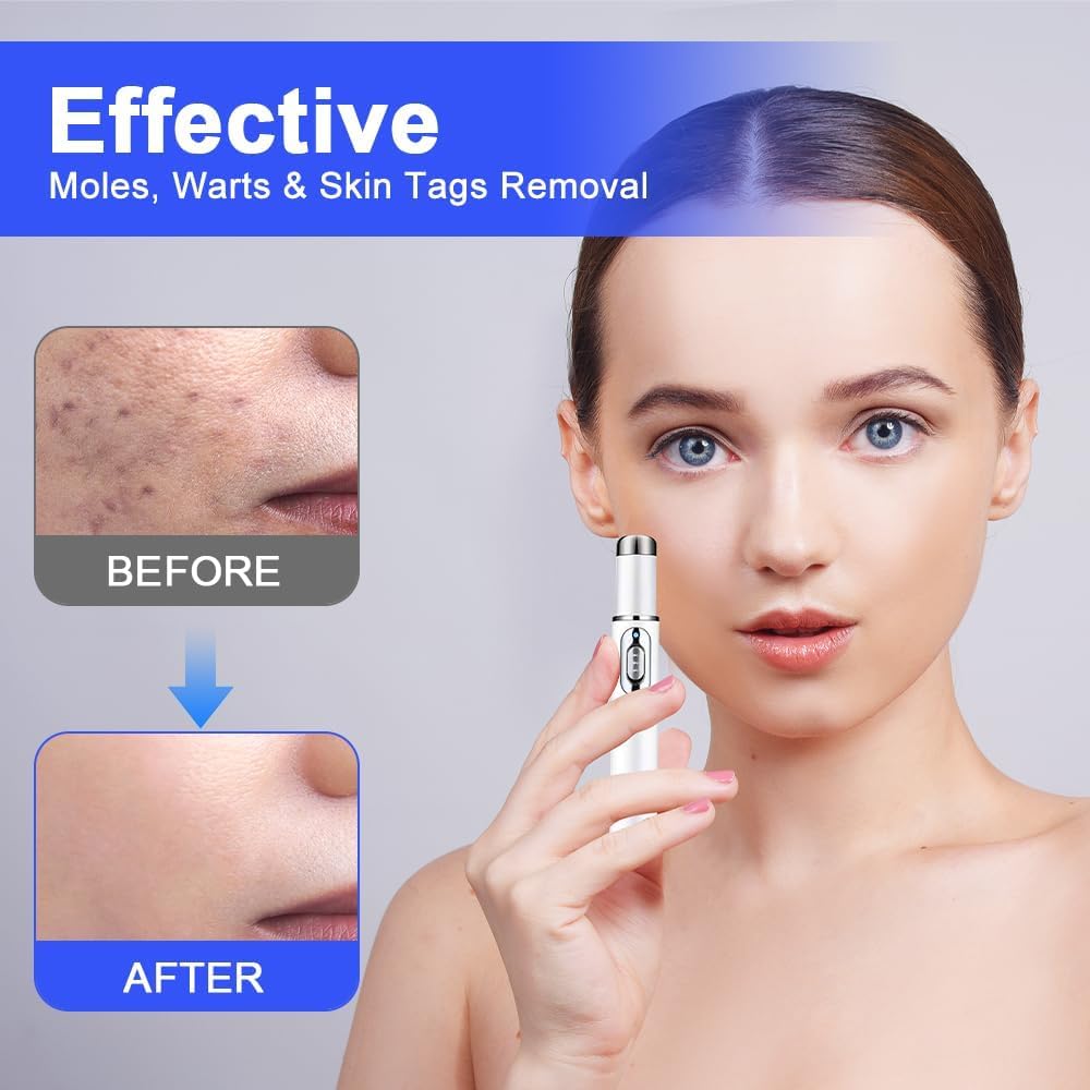 Penna laser non invasiva per la rimozione di lentiggini e verruche, penna laser per la crescita della pelle di viso e corpo, adatta per la rimozione di verruche, acne e nei