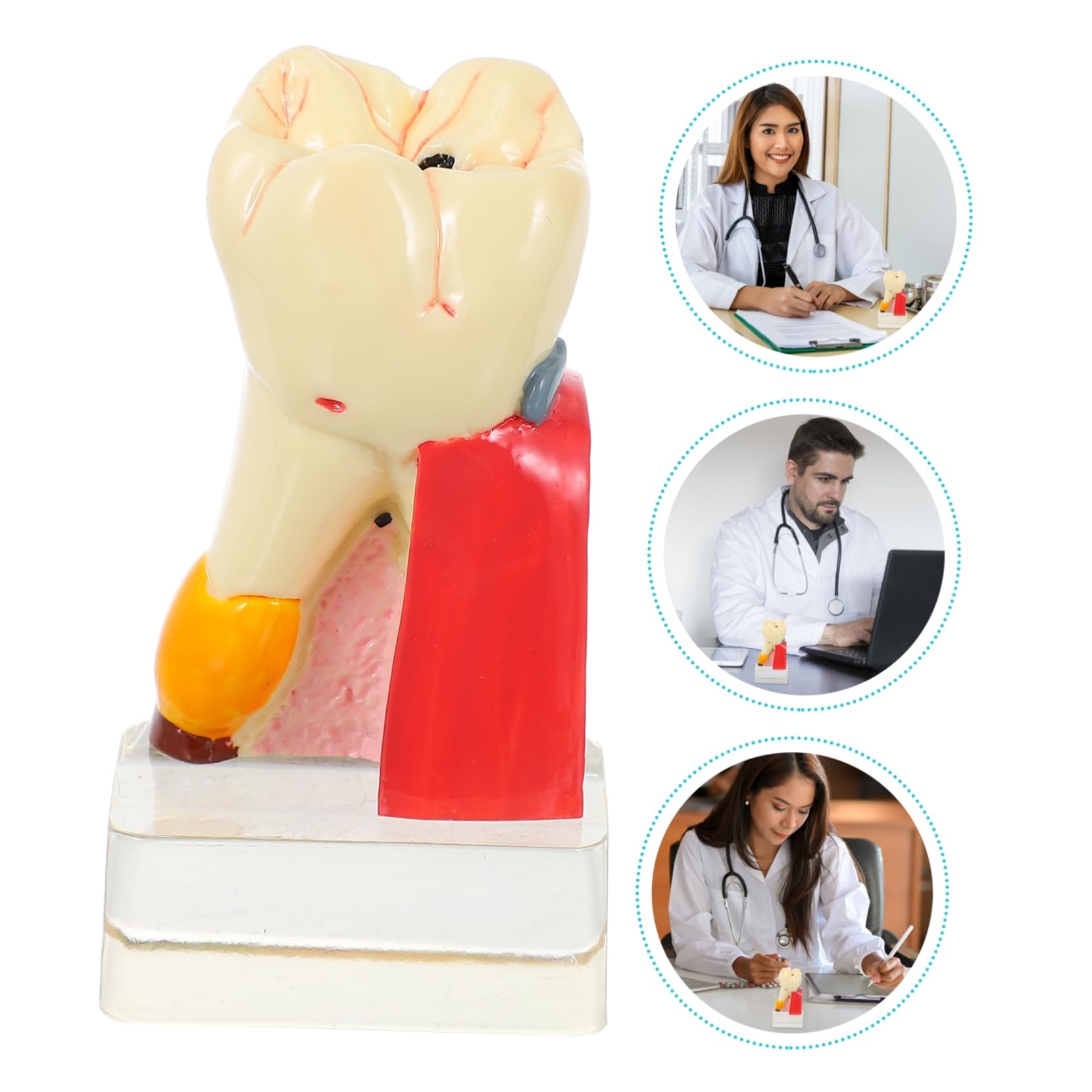 4volte Modello Anatomico di Carie per Studi Odontoiatrici Strumento Didattico per Insegnamento e Dimostrazioni Realizzato in Materiale