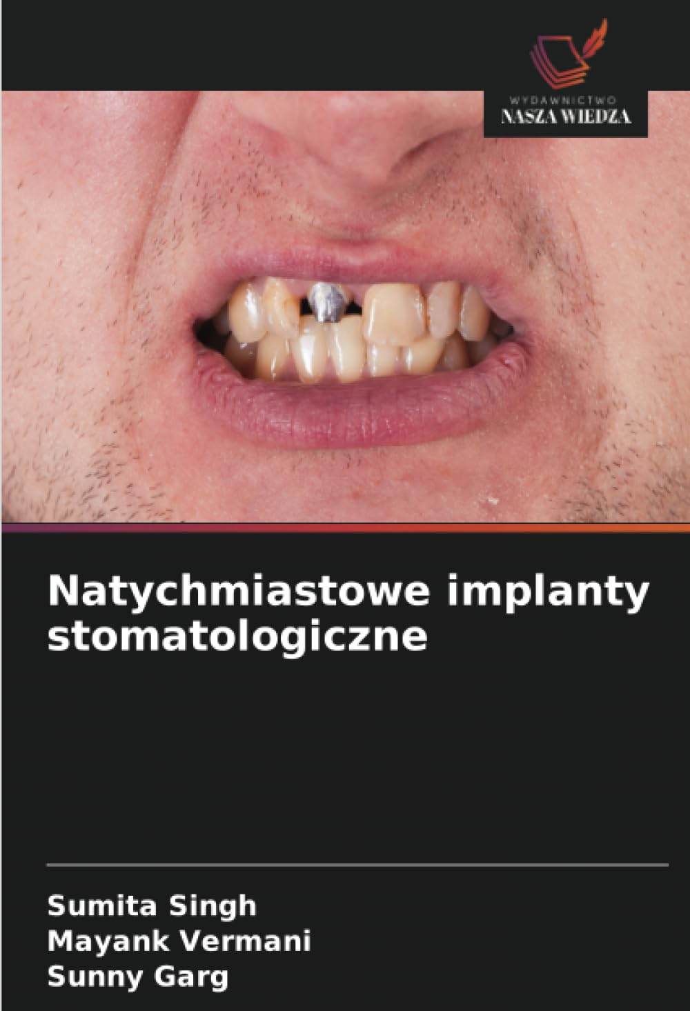Natychmiastowe implanty stomatologiczne