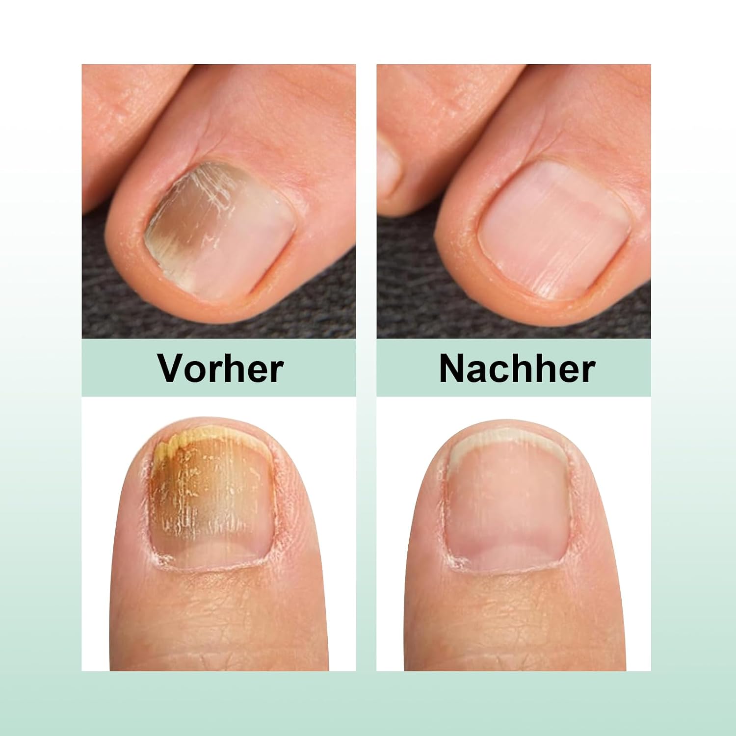 Nail Care Pen, Das Original Nail Care Pen Für Fingernägel & Fußnägel, Nail Care Stift öSterreich, Nägel nähren Nail Care Stift 2er Set - 4