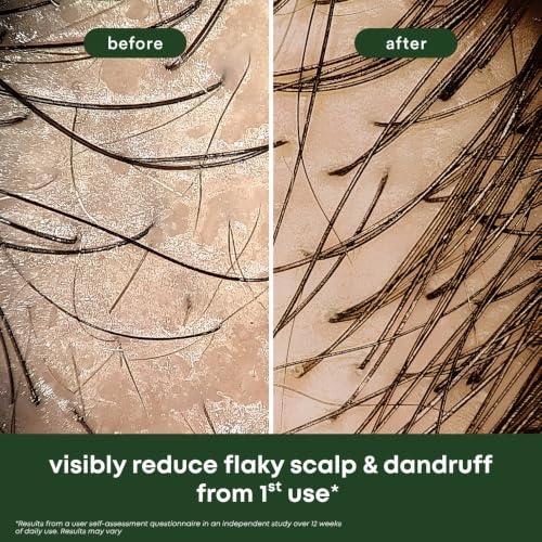 Image of Hair Growth Serum + Anti Dandruff & Hair Fall Control Shampoo | Rosemary, Castor, Bhringraj, Tea Tree, Neem & more| Reduces Hair Fall & Controls Dandruff | Sulphate Free (40ml + 100ml)