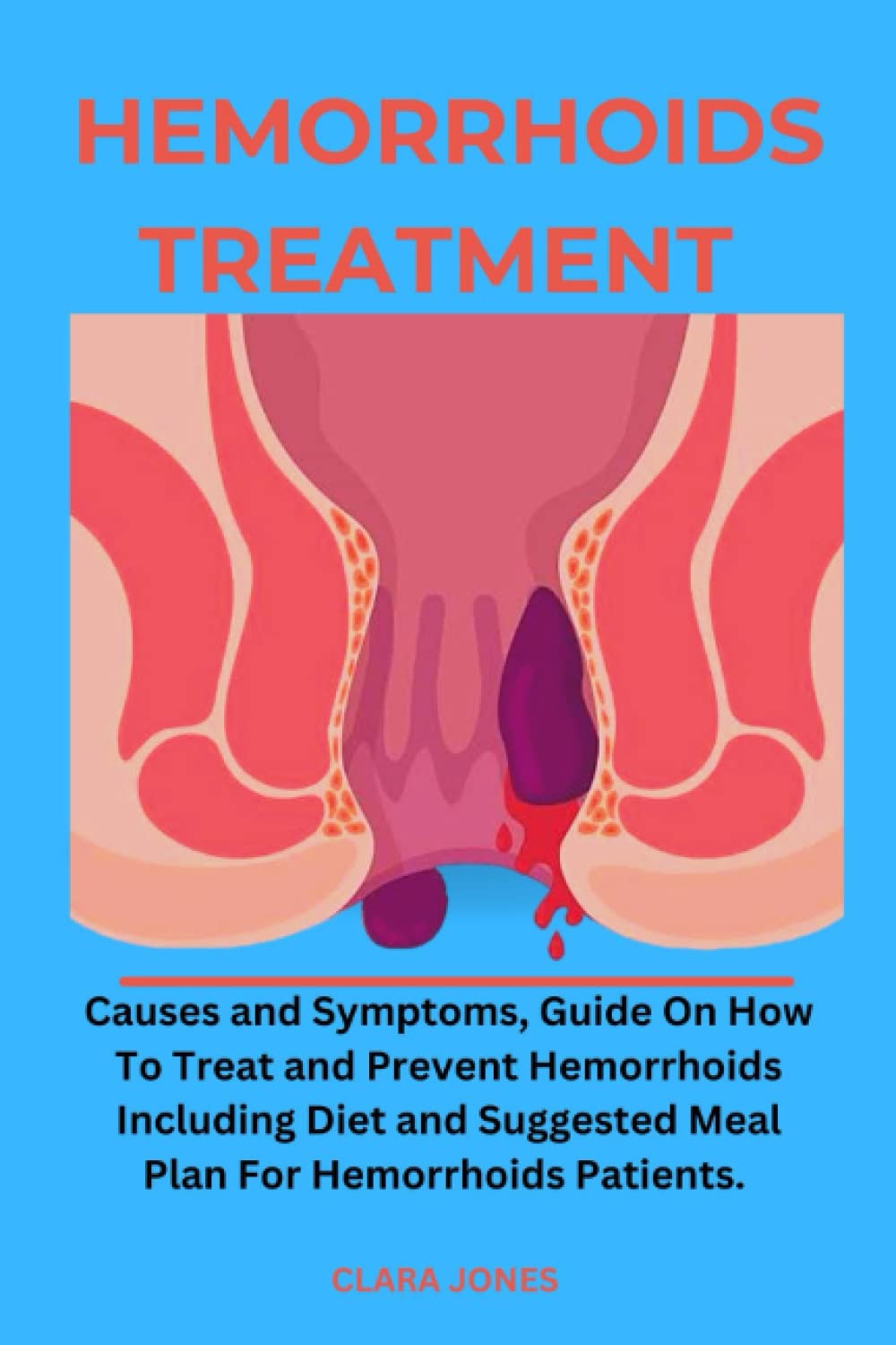 Hemorrhoids Treatment:: Causes and Symptoms, Guide on How To Treat and Prevent Hemorrhoids Including Diet and Suggested Meal Plan For Hemorrhoids Patients.