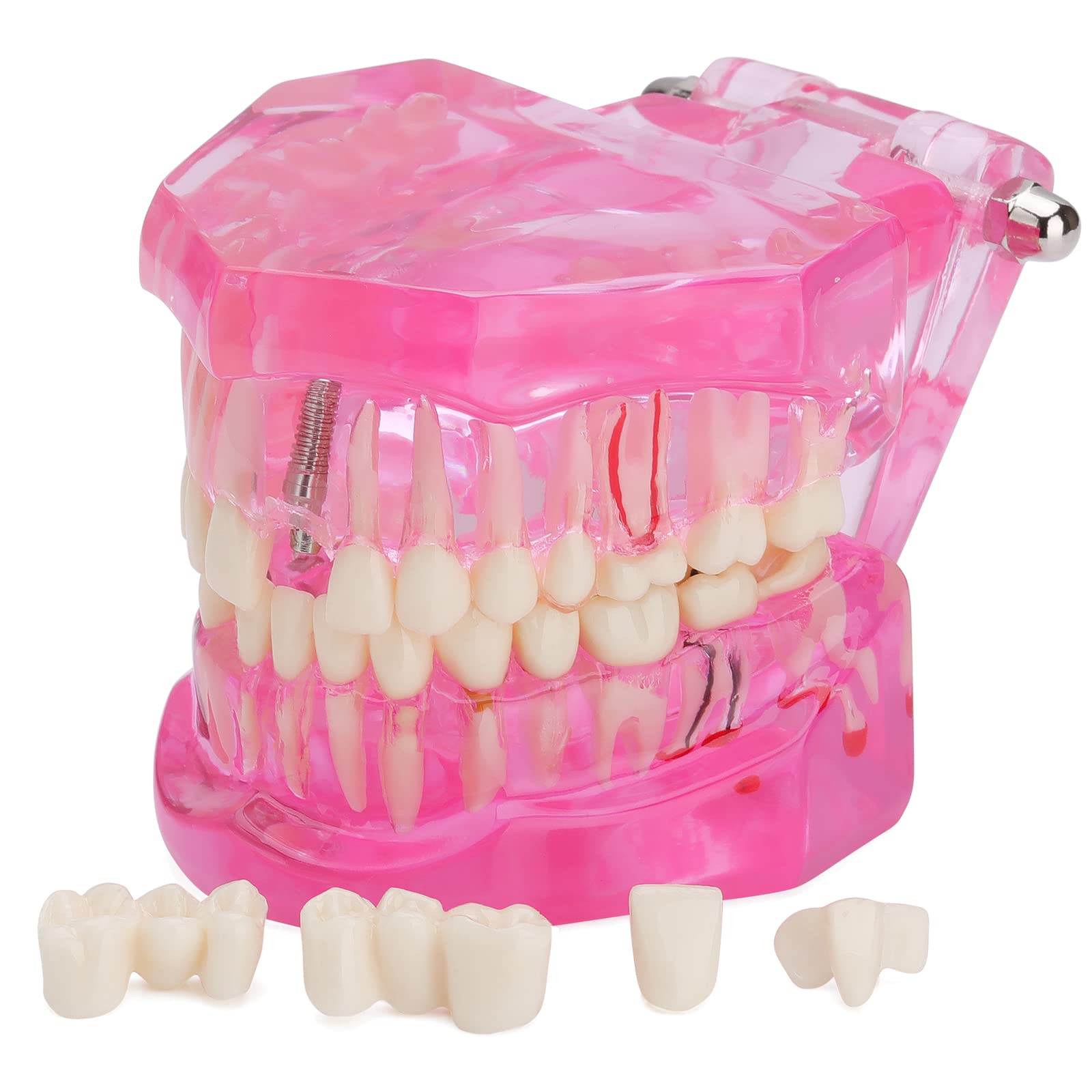 LVCHEN Transparent Dental Implant Teeth Model - Transparent Disease Teeth Model Pathological Tooth Model with Removable Teeth for Dental Study and Education