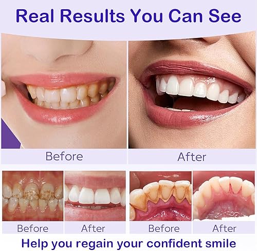 Miniatura 7 de Polvo Blanqueador Dental con 20,000ppm de Hidroxiapatita y 20,000ppm de Niacinamida  Iluminación Instantánea, Complejo Remineralizante R5X en