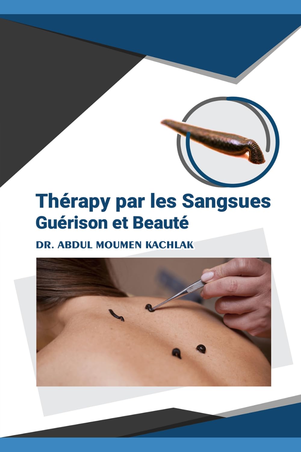 Thérapie par les sangsues: Hirudothérapie en médecine moderne