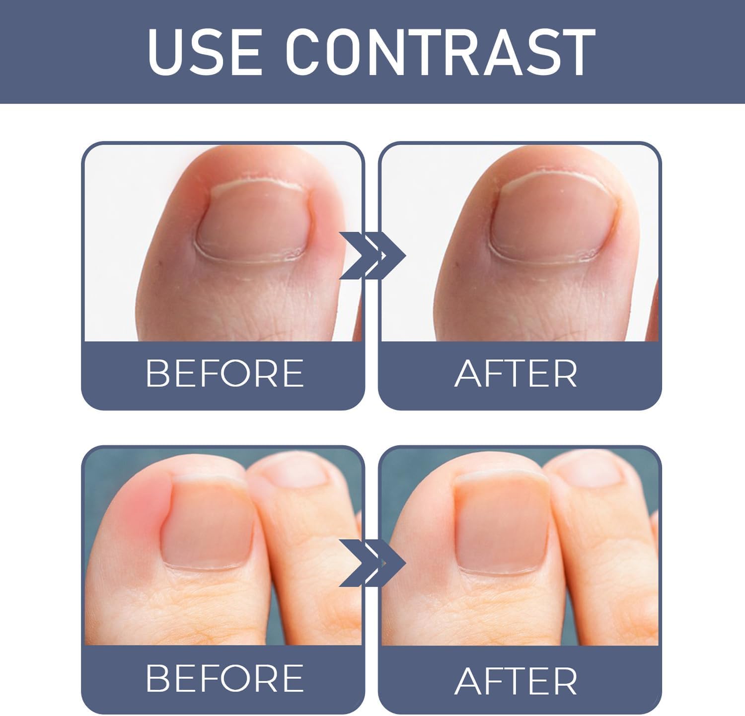2 PCS Ingrown Toenail Care Oil, Softening Toe Nail Solution for Easy Trimming, Gentle Formula for Nail Edges - Image 4