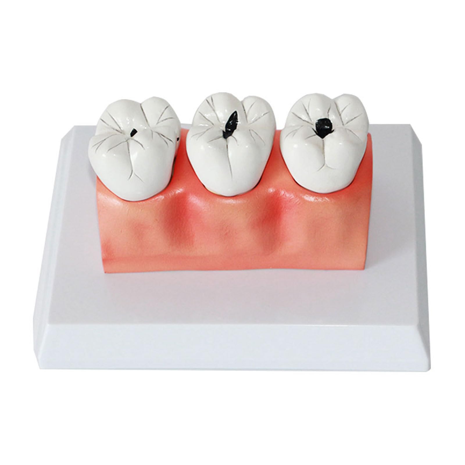 Modelli di comparazione della Carie 4 Volte Modello di decomposizione della Carie Denti sezionati Modello per la Ricerca didattica Modello di Studio per Studenti di odontoiatria