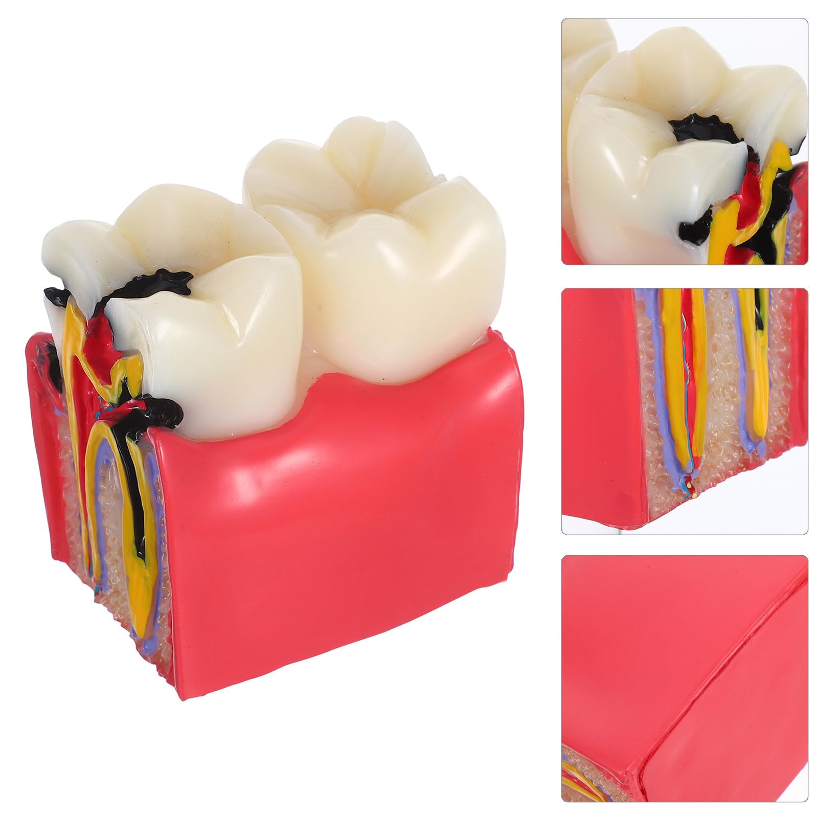 BESTYASH Modèle Pédagogique de Caries Dentaires à 6x Grossissement en Résine, Outil Typodont D'anatomie Comparée Dents Saines Vs Cariées, pour Enseignement en École et Cabinet