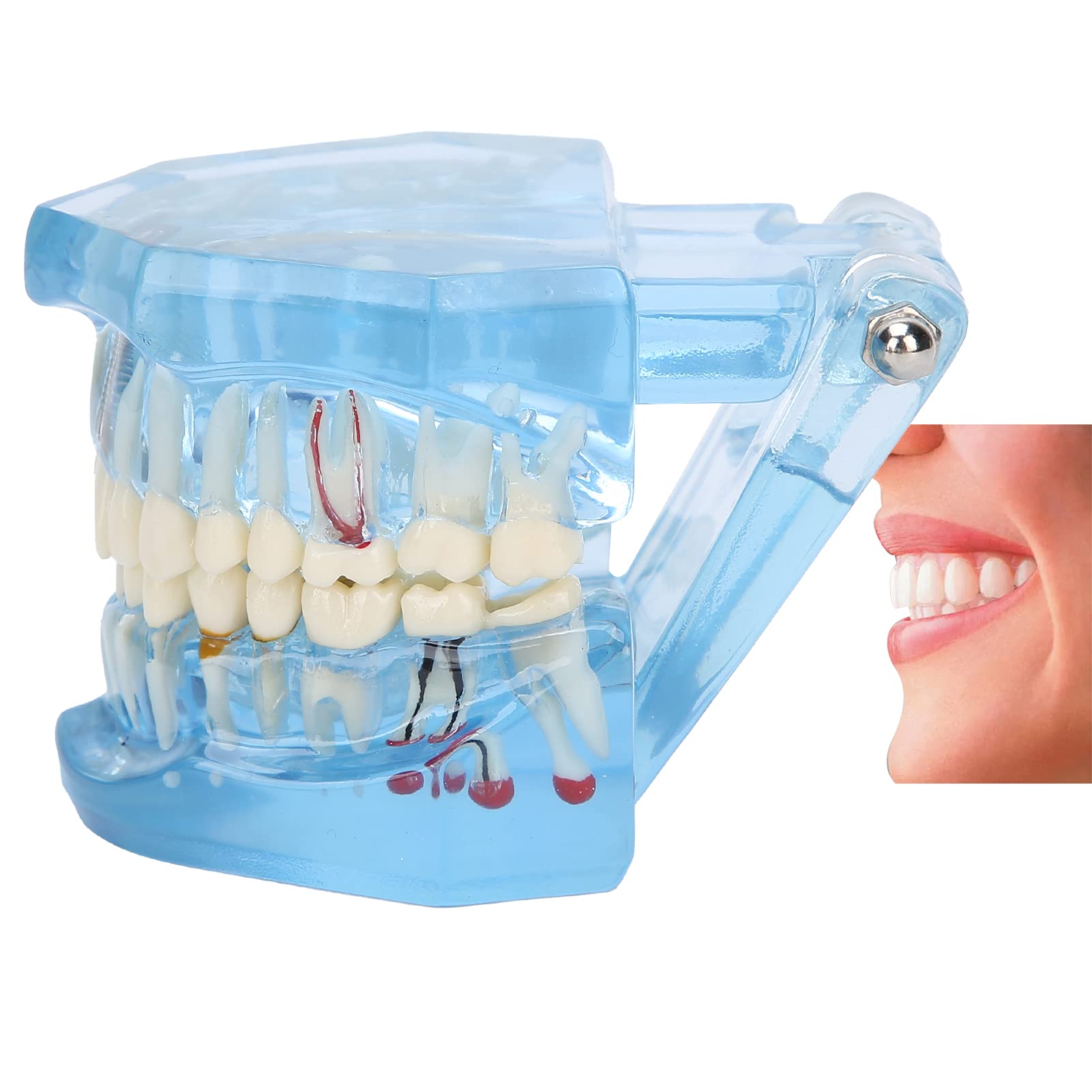 Dentier Modèle D'enseignement, Bleus En Acrylique Transparent Modèle Dentaire, Prothese Dentaire Amovible, Modèle Pathologique pour l'étude et l'éducation