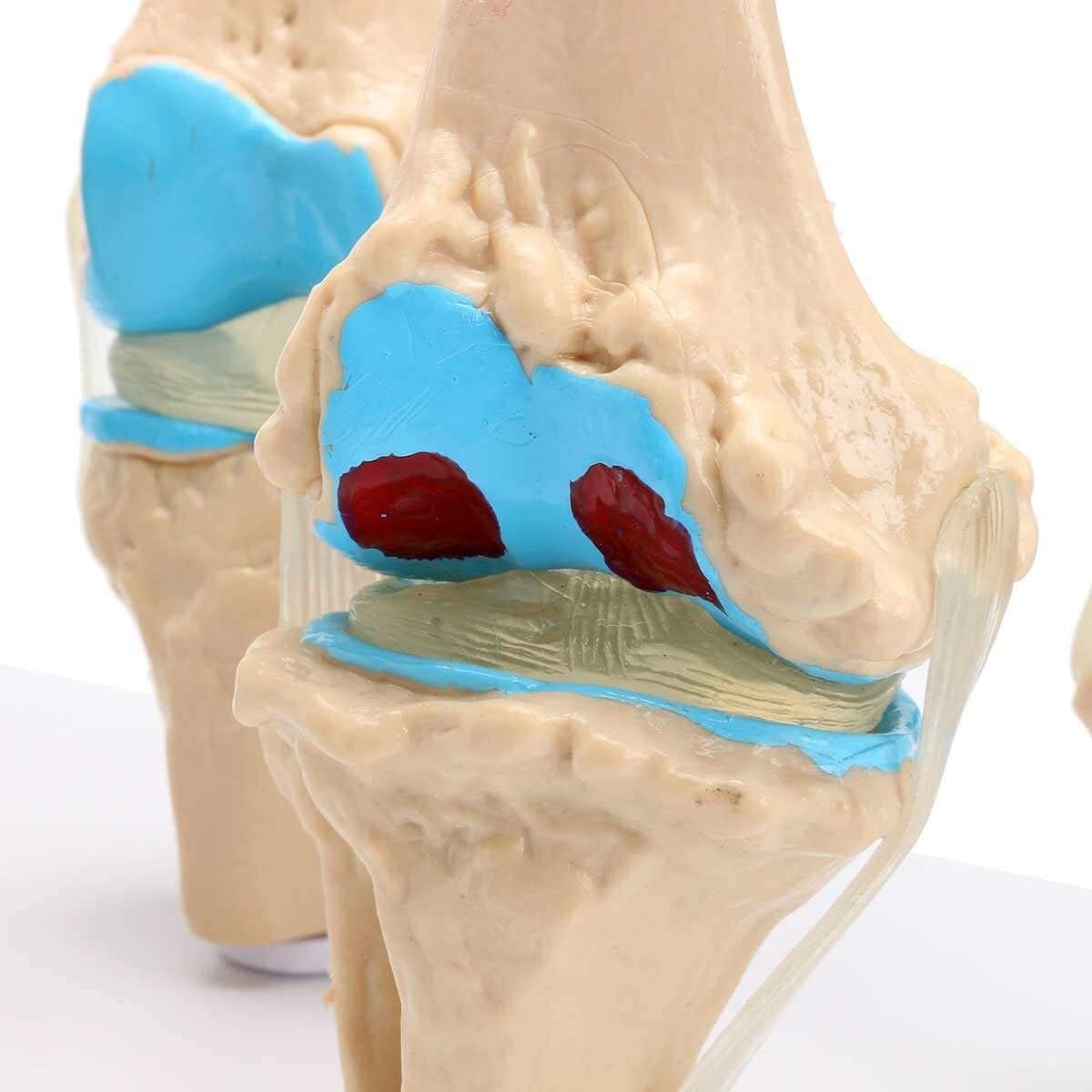 Modele medyczne, ludzki szkielet stawu kolanowego Model anatomiczny nauka medyczna materiały dydaktyczne osteoporoza modele stanu chorobowego 1 zestaw odłączany