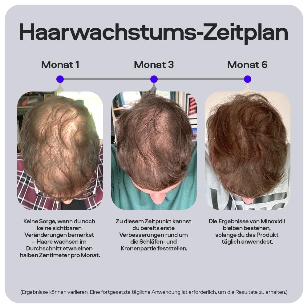 Sons Minoxidil 5% Lösung & 0.25mm Dermaroller für Männer, Haarwachstum
