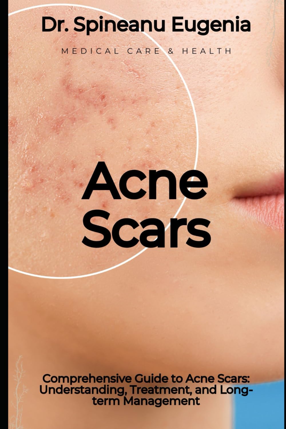 Comprehensive Guide to Acne Scars: Understanding, Treatment, and Long-term Management (Medical care and health)