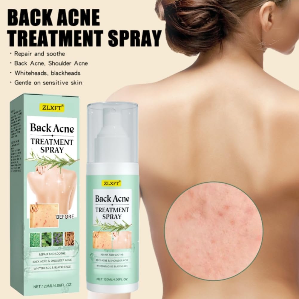 Torna Soluzione Brufolo,2pcs Spray per Brufoli Corpo,Spray per la Rimozione dei Brufoli Sulla Schiena,Post Acne Trattamento Sprays,Acnes Sprays Back And Chest,Body Acnes Sprayss