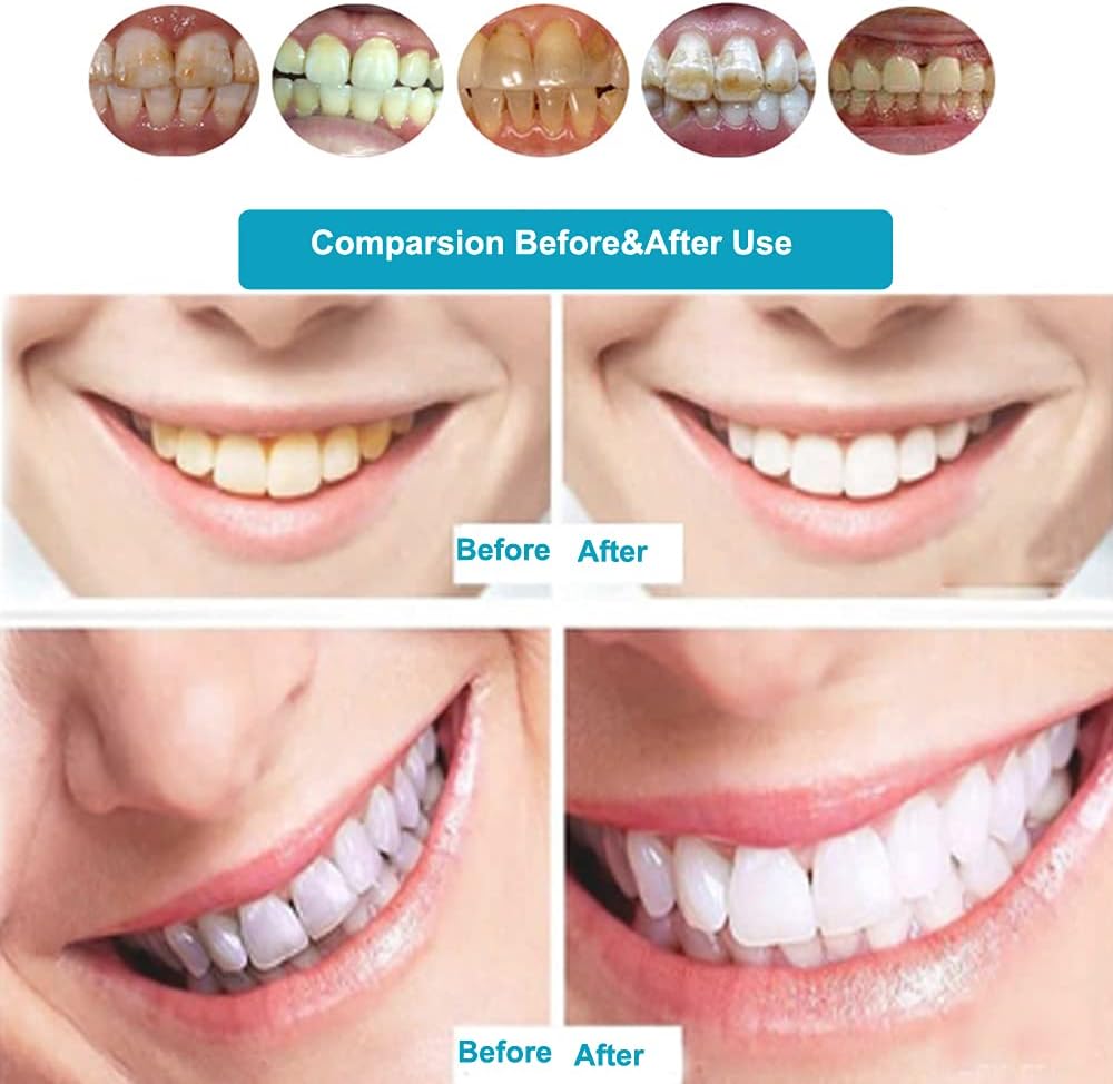 Remote Control Mobile Teeth Whitening Lamp 36W 10 LED Dental LED Teeth Whitening Accelerator 3 Colors Blue/Purple/Red Light Teeth Whitener Bleaching System with Mouth Opener/Goggles/Bibs 110V : Everything Else