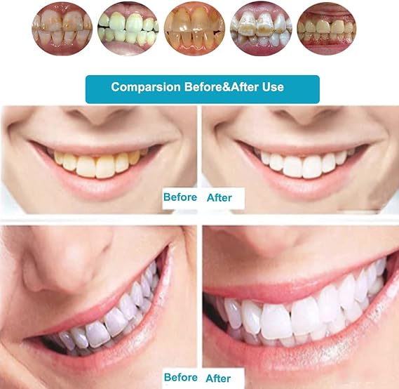 Dental Mobile Teeth Whitening Lamp with 8Pcs LED Cold Blue Light Tooth Whitening Bleaching Accelarator 24W