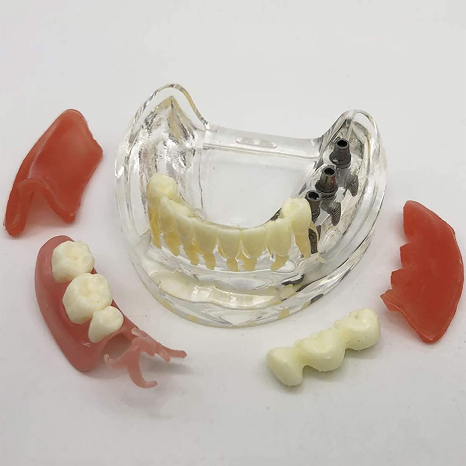 PEAMAN Modello di Cure odontoiatriche, Modello di impianto Dentale e restauro dei Denti a confronto con gengiva e Protesi Rimovibile per Lo Studio e la dimostrazione didattica
