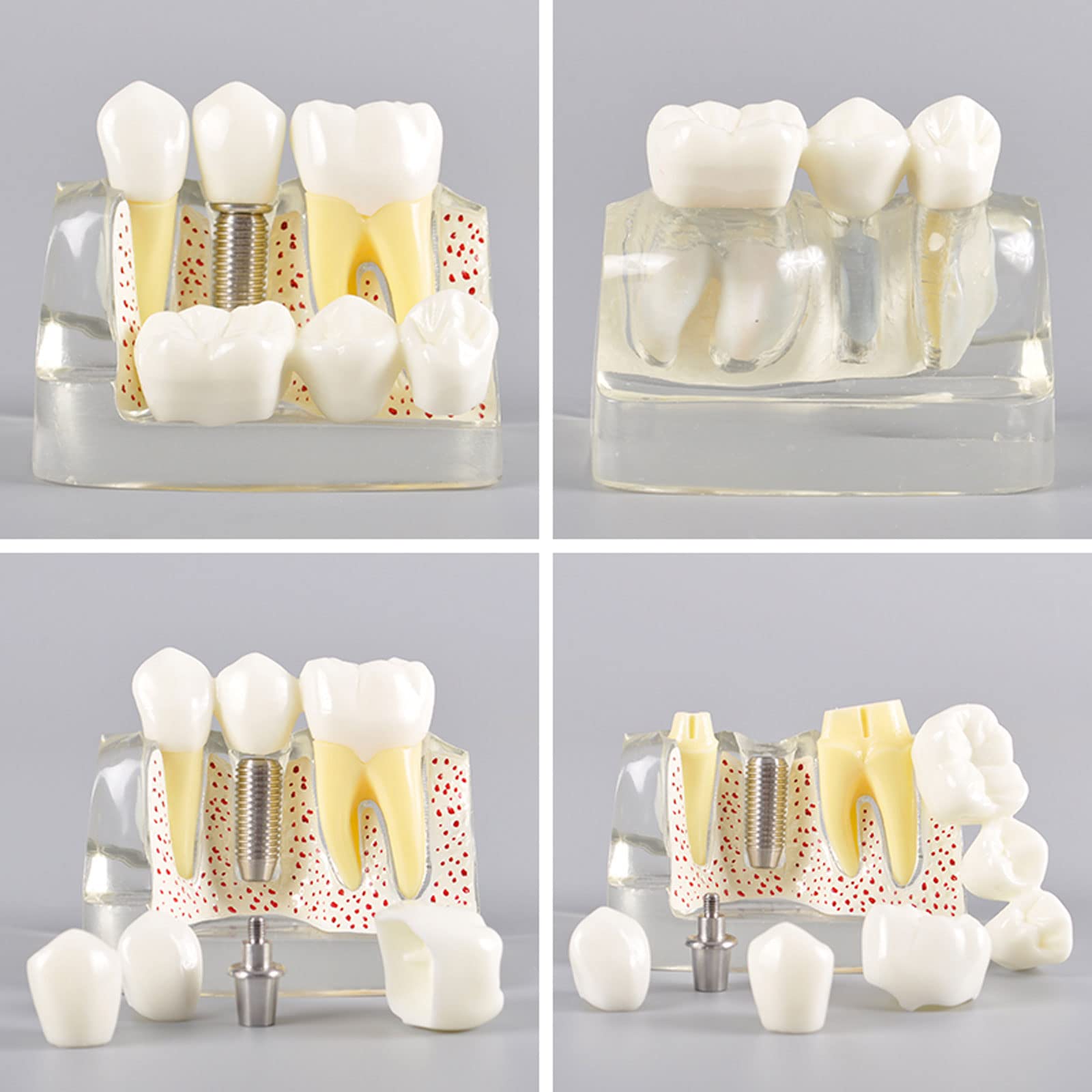 Modello di Denti Analisi, Modello Dentale per Dimostrazione dello Strumento di Insegnamento Dentale in Studio,Denti Analisi Impianto per L'insegnamento e Ricerca Odontoiatrica