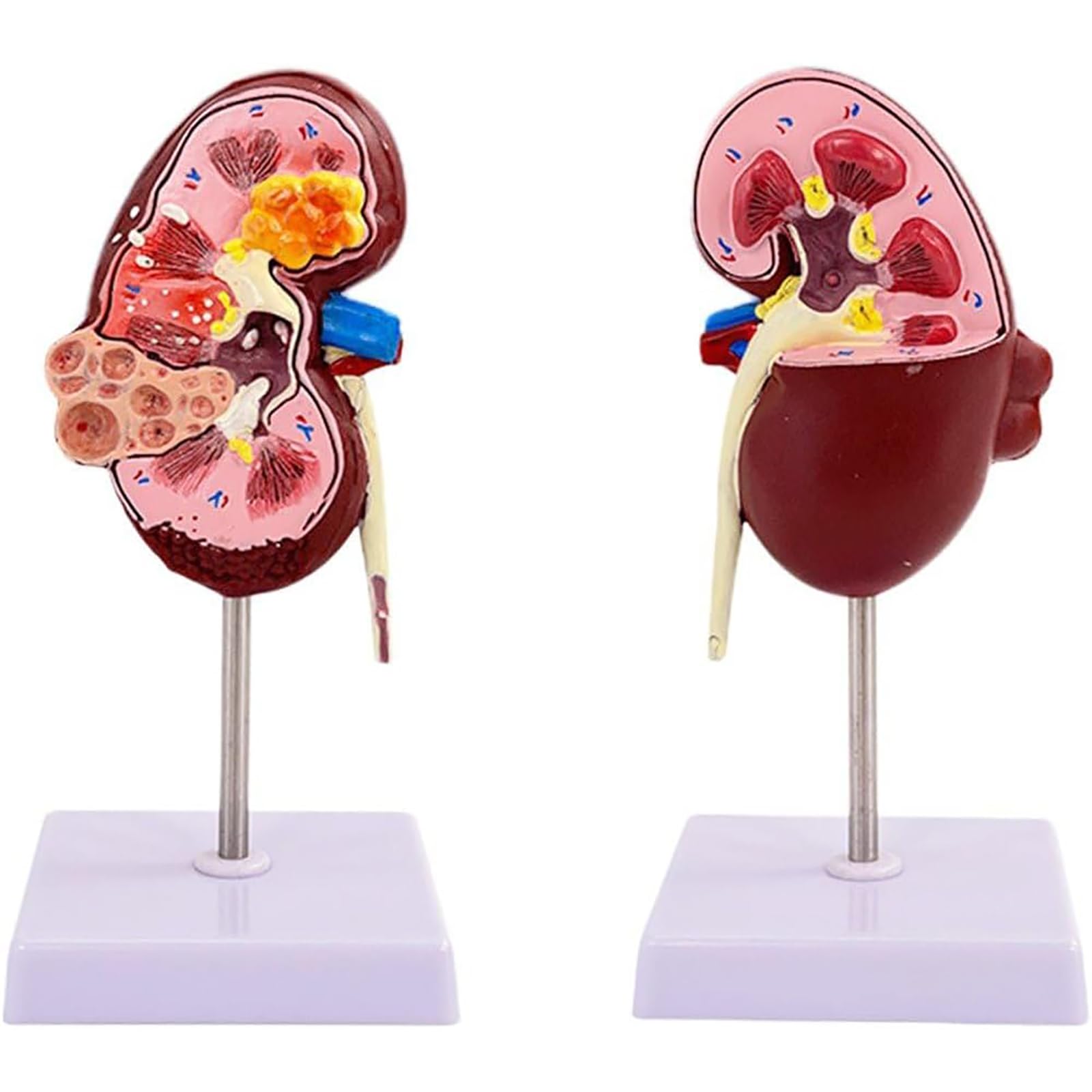 Kidney Pathologies Model 2 Side Human Kidney Model Human Body Anatomy Model Medical Educational Tool for Training