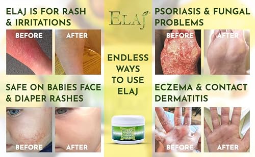 Elaj All Natural Eczema Skin Care Moisturizing Lotion Cream, Helps Psoriasis, Rosacea, Dermatitis, Anti Itch Hives, Bug Bites, Dry Skin, Baby Cream - No Cortisone, Hydrocortisone, Triamcinolone (1Oz) #TOP1