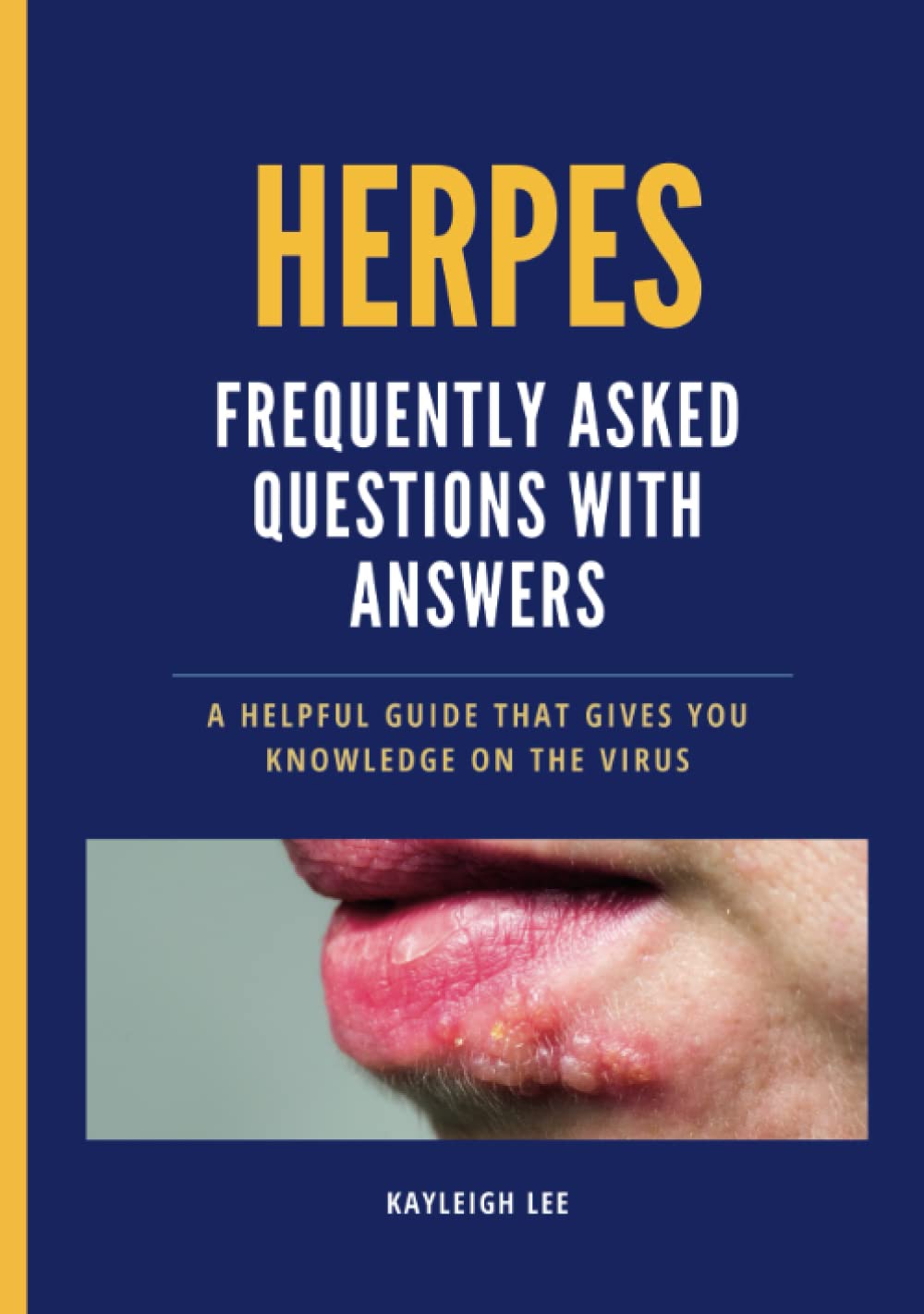 Genital and Oral Herpes FAQ Frequently Asked Questions About Herpes