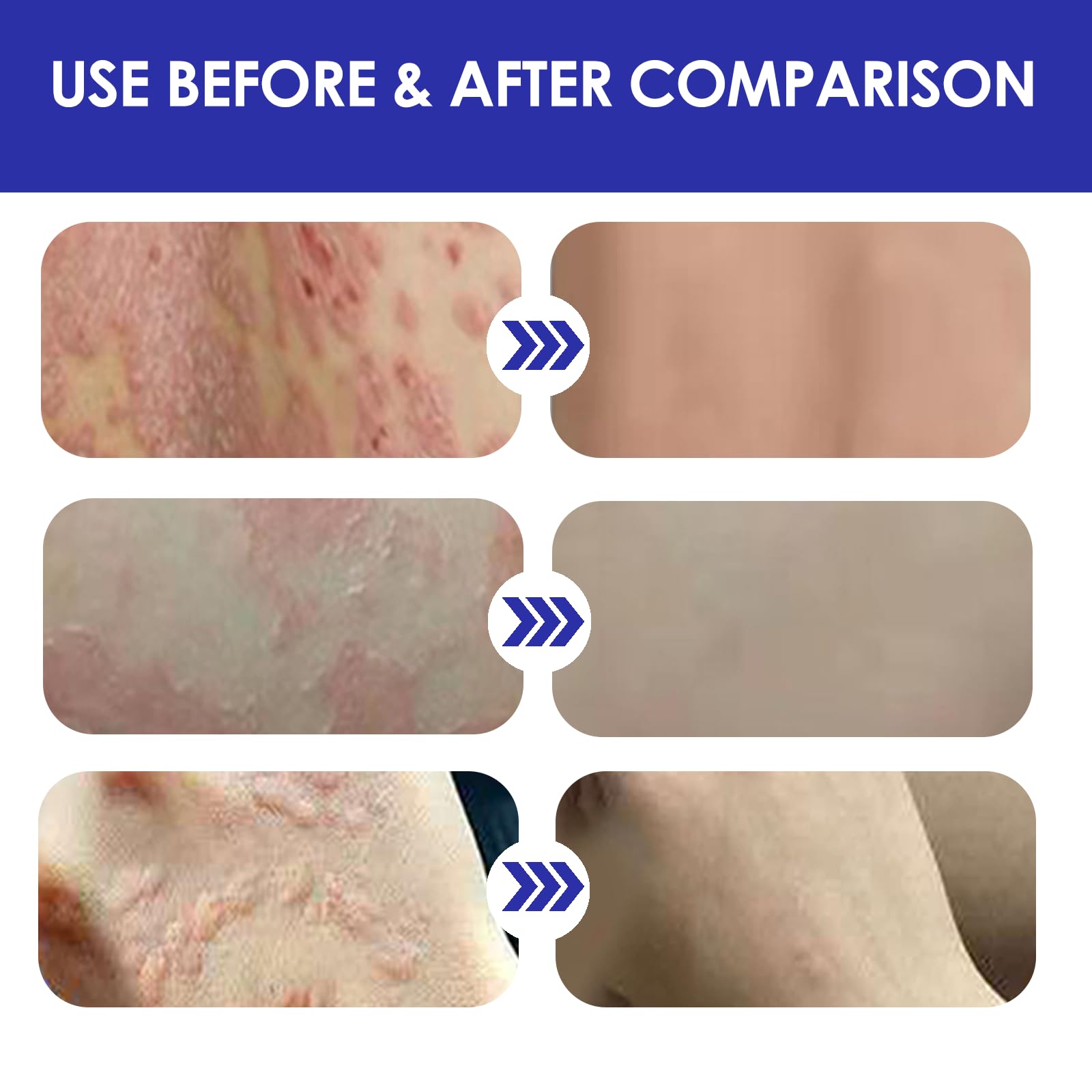 20g Crema per Eczema,Crema Corpo Lenitiva,crema Idratante,efficacemente Nutre la Pelle Secca,Adatta a Viso e Corpo