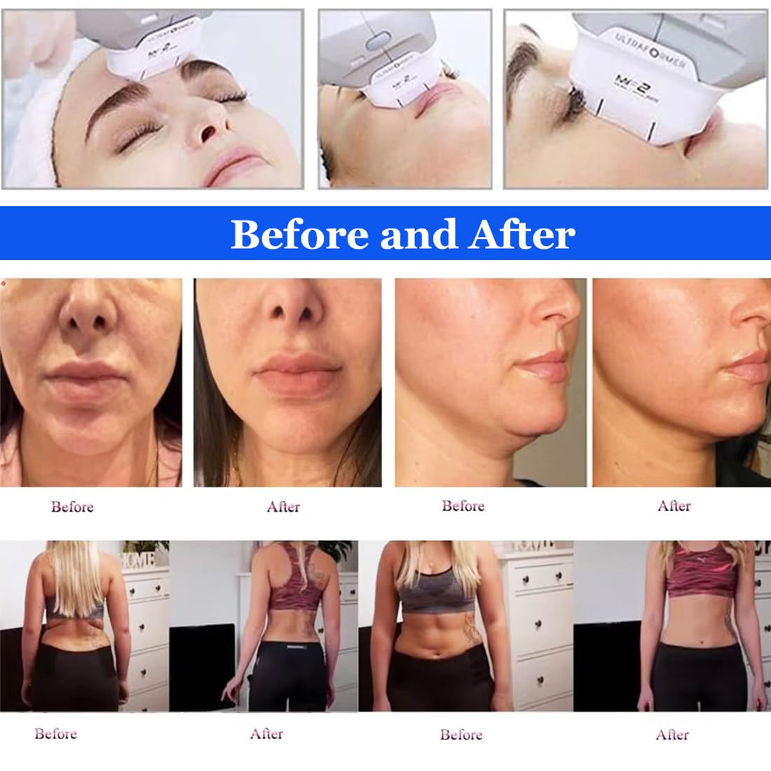 Macchinario Estetico Multifunzione HIFU Schermo HD 15",Rimozione Rughe,Lifting Facciale,Macchina Dimagrante,Trattamenti Viso/Corpo in 30 Minuti | Risultati Visibili Subito