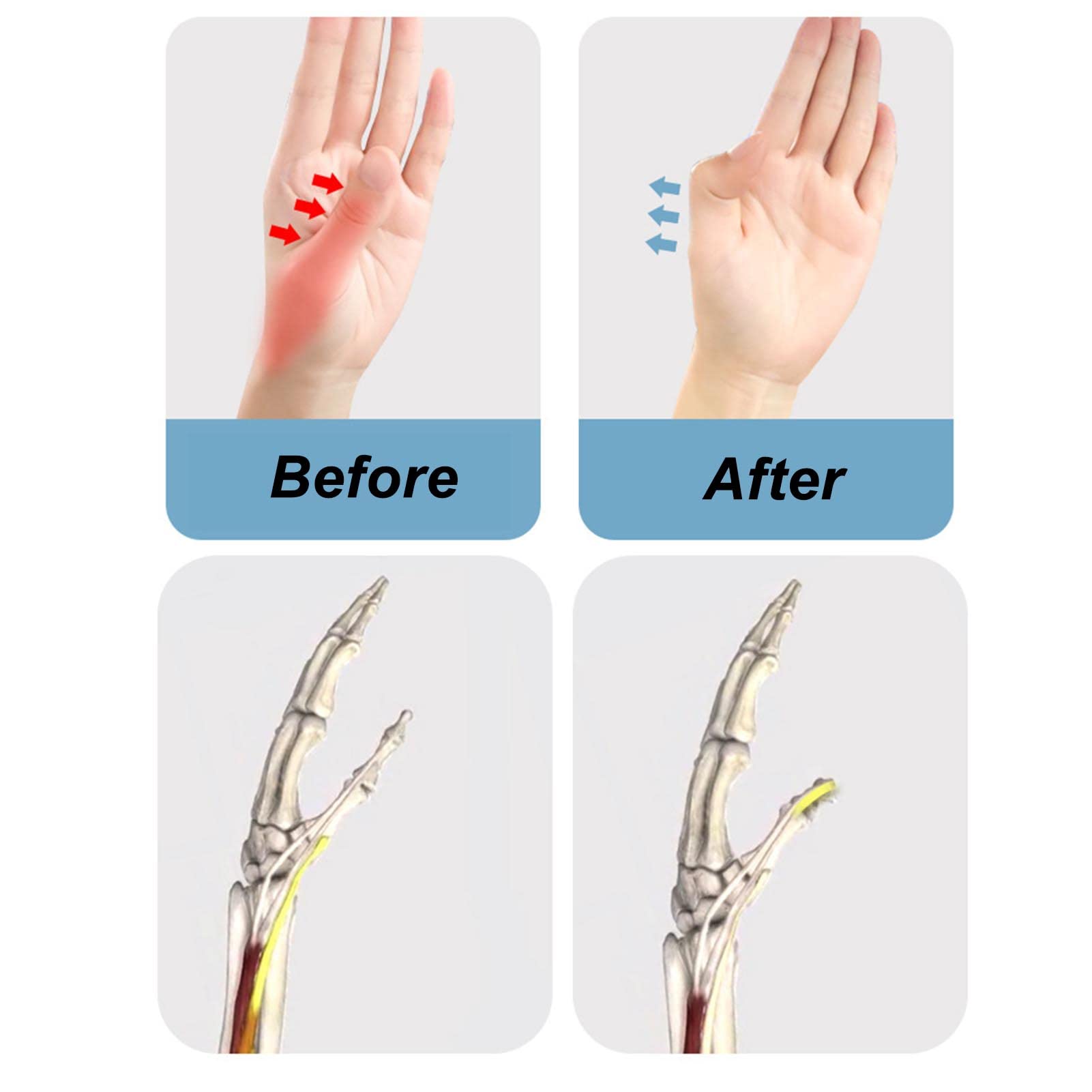 Soft Adjustable Wrist Thumb Support Brace, Finger Splint for Tendonitis Relief with Silicone Compression Strip Skin Color (Left Hand)