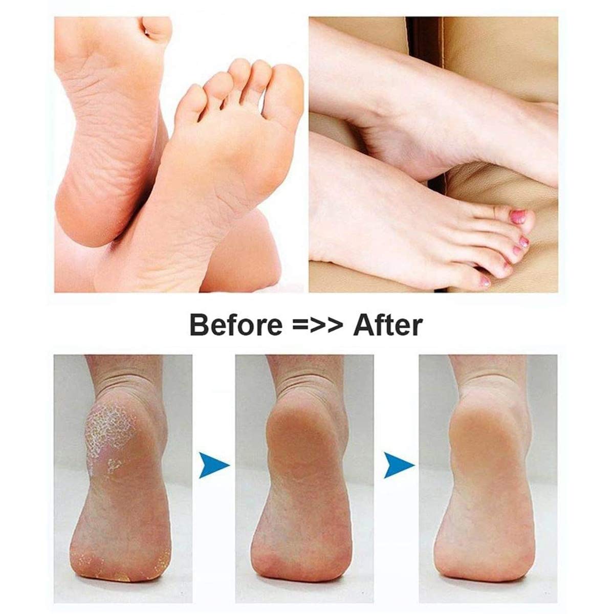 MIAOZHANG Raspa Piedi Professionale Elettrica Pedicure Elettrico Attrezzi per Pedicure Ricaricabile Cura dei Piedi per Eliminare Duroni Calli Pelle Morta Cornea,B