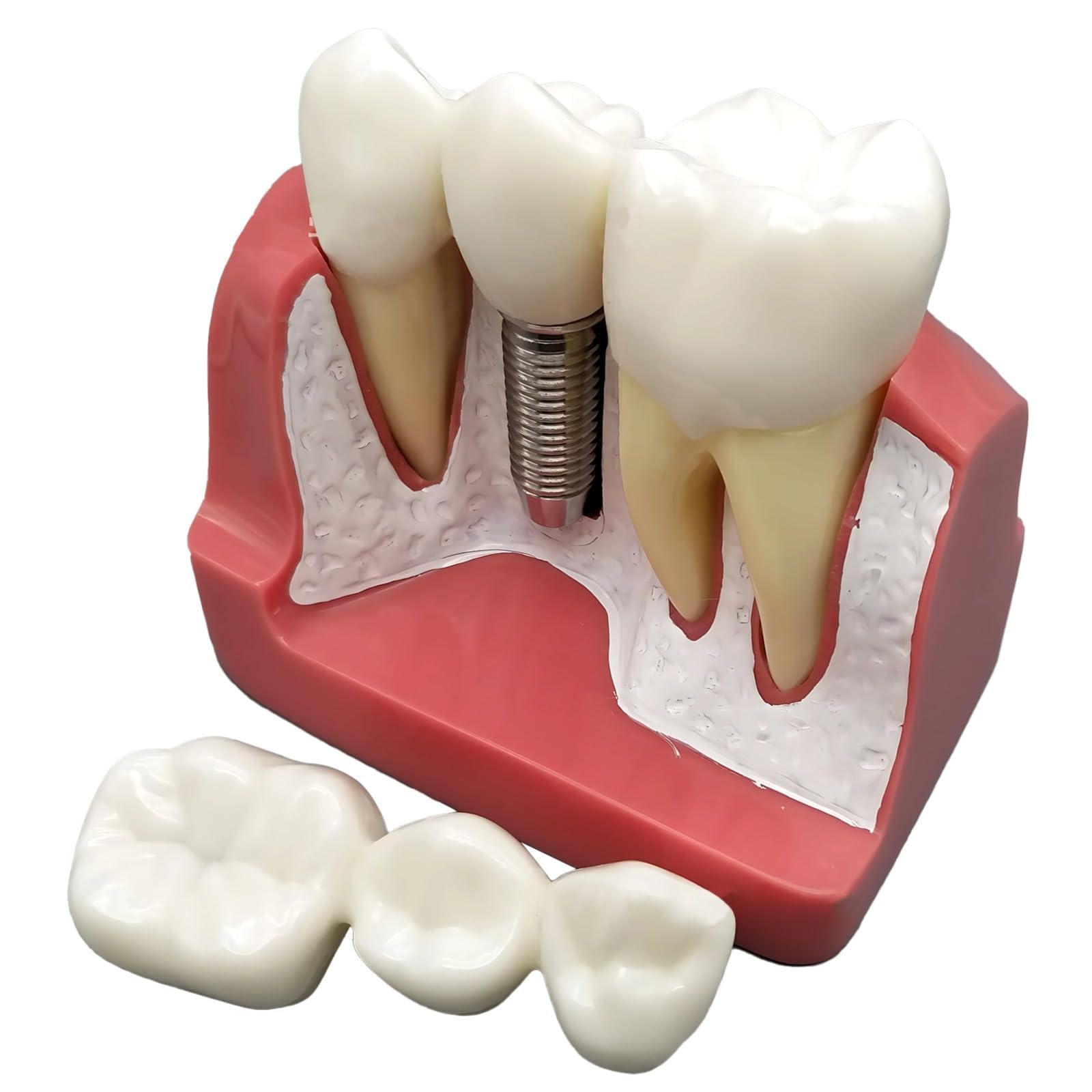 Model implantu dentystycznego do edukacji, renowacji korony i mostów, zdejmowane narzędzie dydaktyczne, powiększony model pacjenta do ćwiczeń, rozmiar 4 razy życia