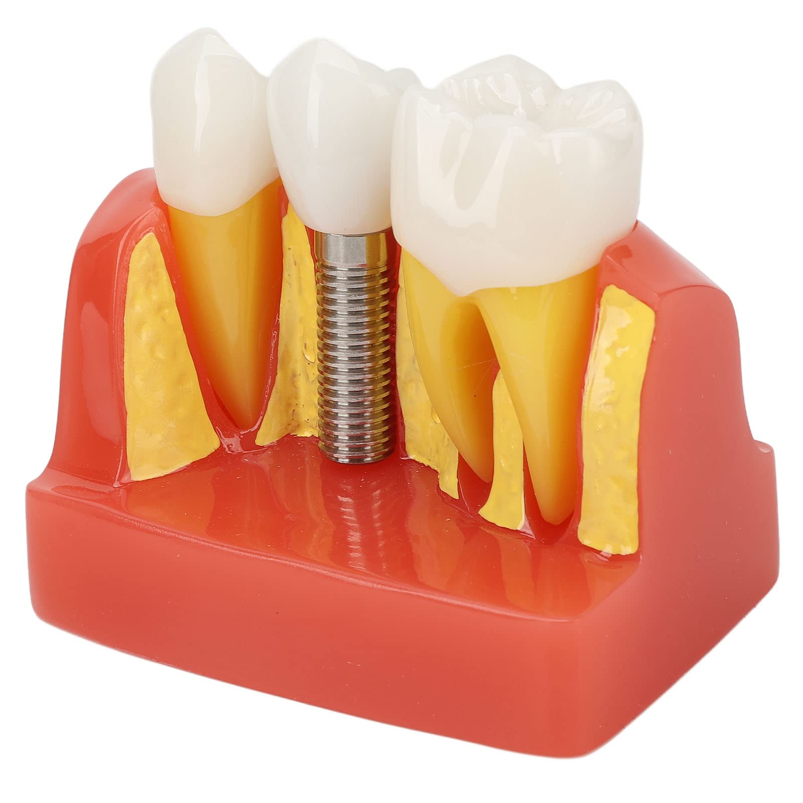 Modelo de implante Dental con Corona y Puente extraíbles para demostración y formación