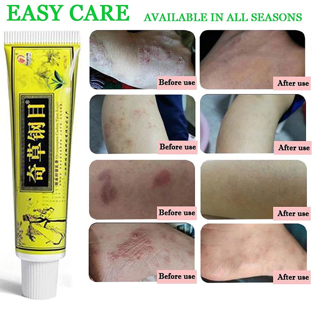 6pcs/Lot Chinese Herbal Eczema, Psoriasis Creams Dermatitis and Eczema