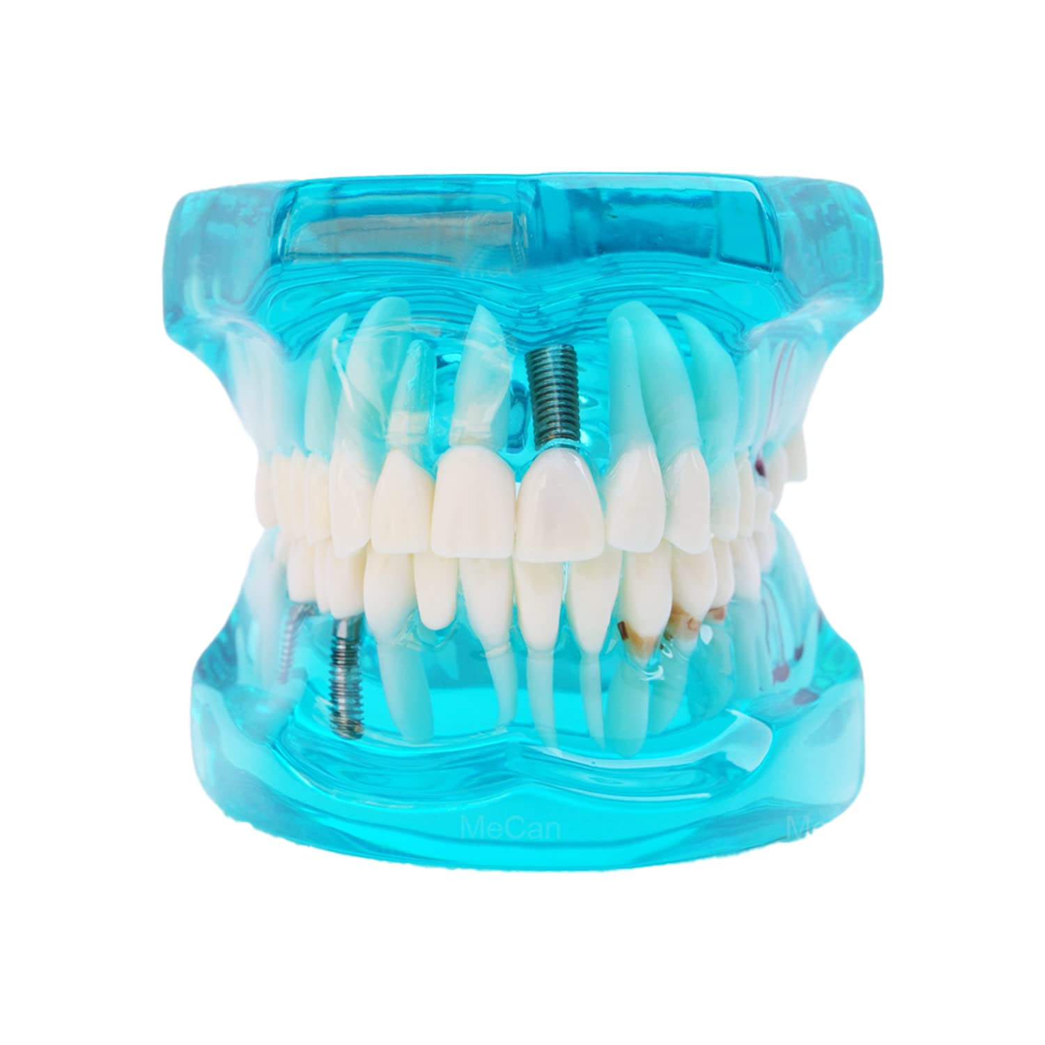 iDENTical All In One Implant & Restoration Model M2001 -Blue (B0B6RKBYLR) Amazon Price History, Amazon Price Tracker