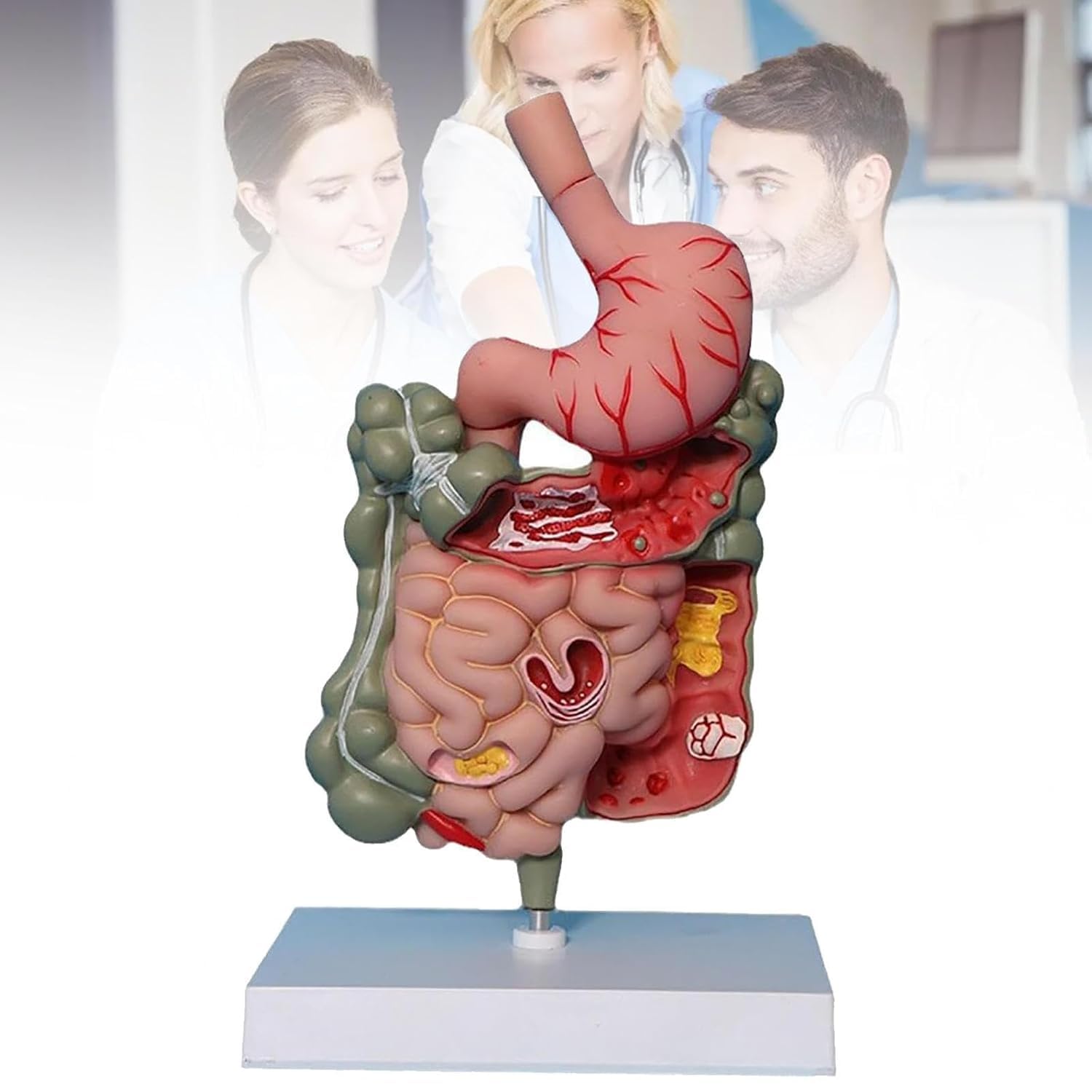 OSPSHPG Human Stomach Anatomy Model, Pathological Digestive System Model, Removerable, Stomach Section Large Small Intestine Medical Model Anatomy, for Learning