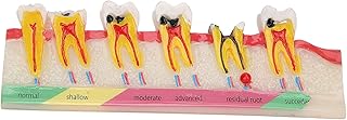 Caries Developing Model, Portable Decayed Teeth Model for Teaching Study - Whole Process Of Caries Development