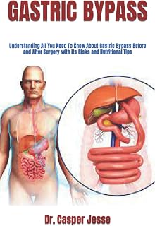GASTRIC BYPASS: Understanding All You Need To Know About Gastric Bypass Before and After Surgery with Its Risks and Nutritional Tips