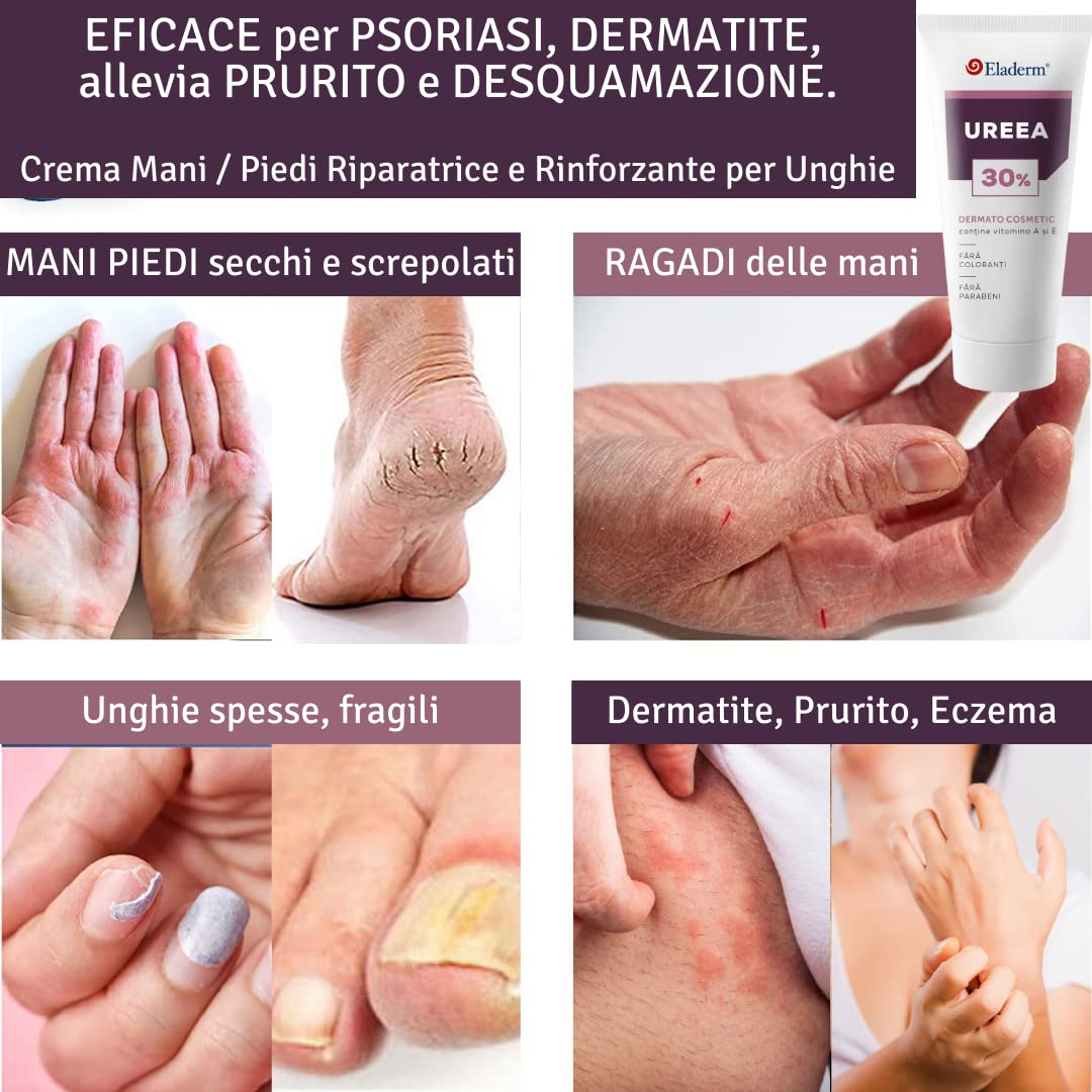 Crema Urea 30%, 100ml, Eczemi, Cheratosi, Psoriasi, Eruzioni Cutanee, Dermatite, Prurito, Piedi Secchi, Talloni Screpolati, Calli, Duroni | Idratazione Profonda | Vitamin A, E, Burro di karitè