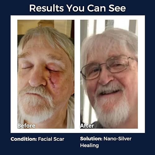 Miniatura 3 de OPTIVIDA Crema de gel de plata coloidal para el cuidado de heridas, curación tópica natural de la piel  Gel tópico de nano-plata para heridas,